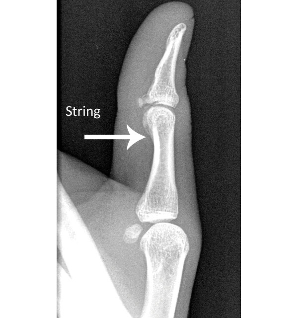 Mastering String Placement for Thumb Draw Archery