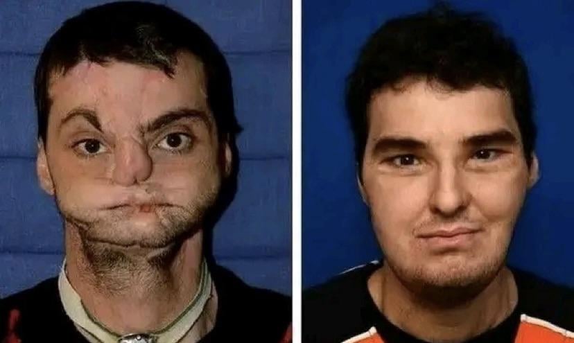 The Intriguing World of Face Transplants