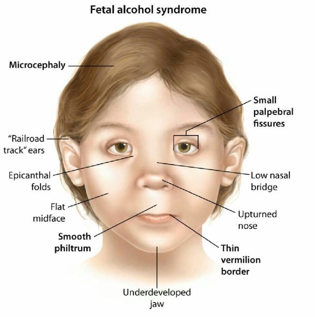 Classic Case of Fetal Alcohol Syndrome