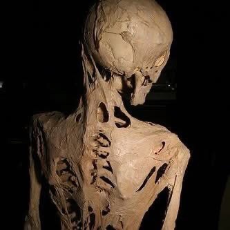 The Rare Disease That Transforms Muscles into Bone