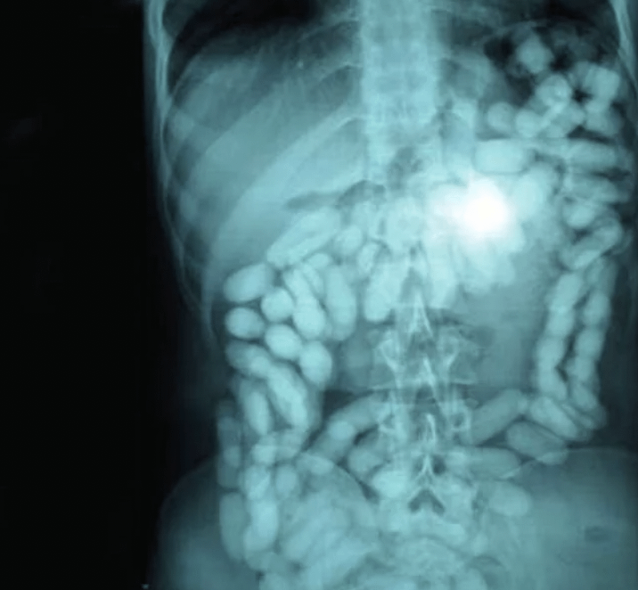 X-ray revealing the secrets of a drug mule.