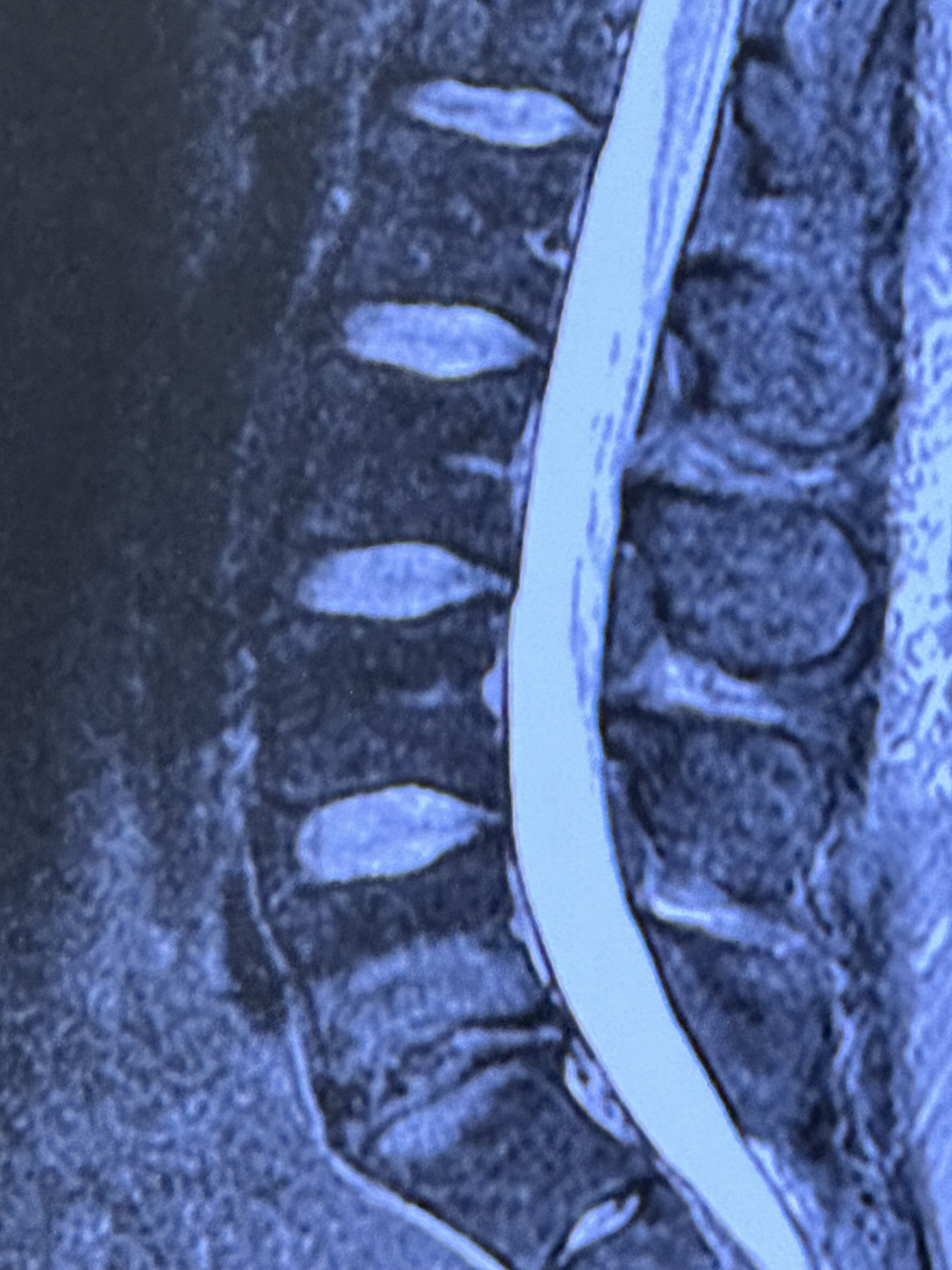 The Struggles of Lower Back Pain