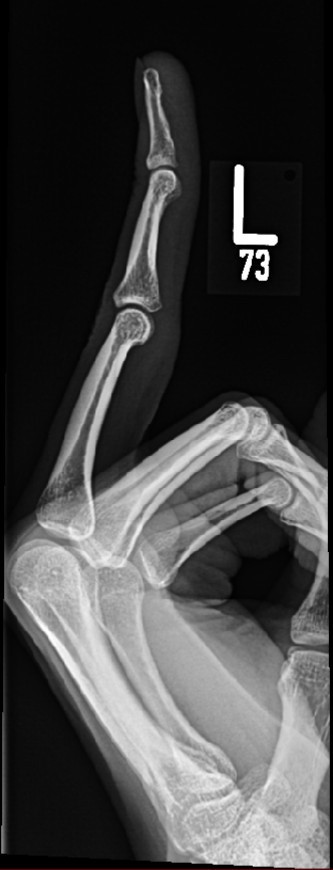Sharing my gift to the internet: an x-ray of my middle finger