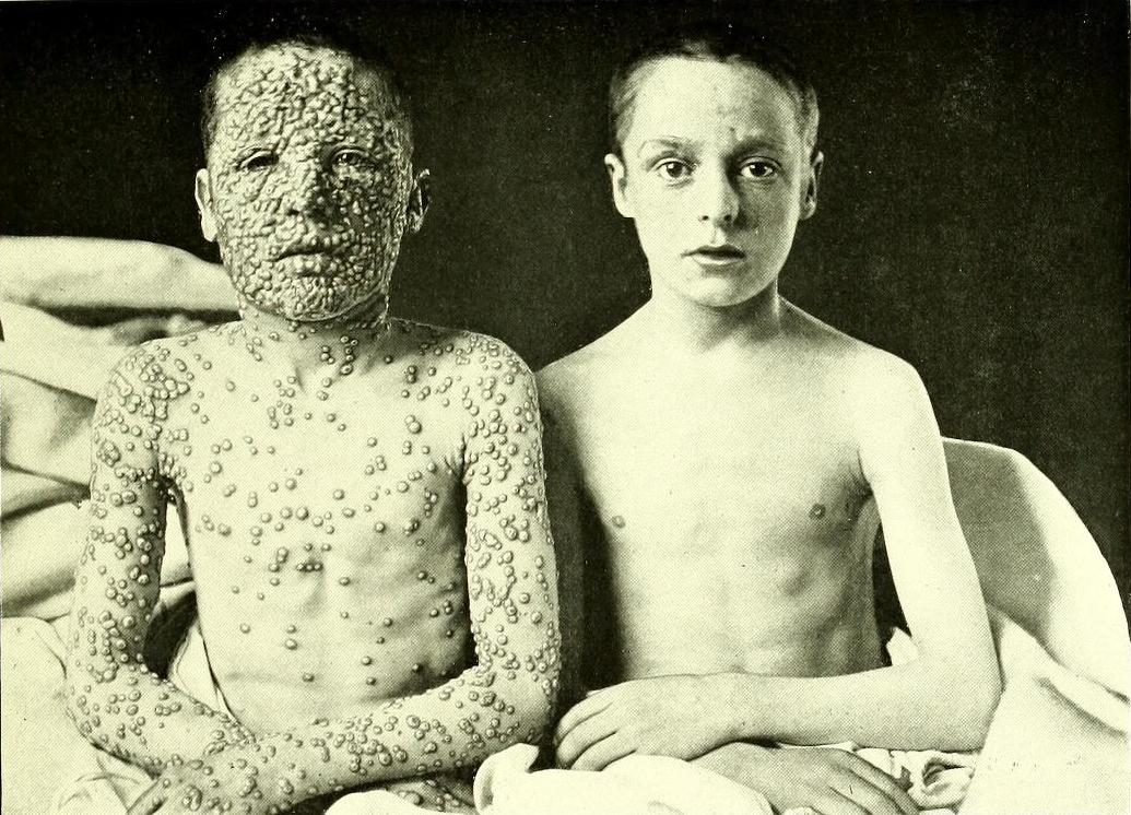Warning: Smallpox could make a comeback if RFK Jr. gets his way with vaccines