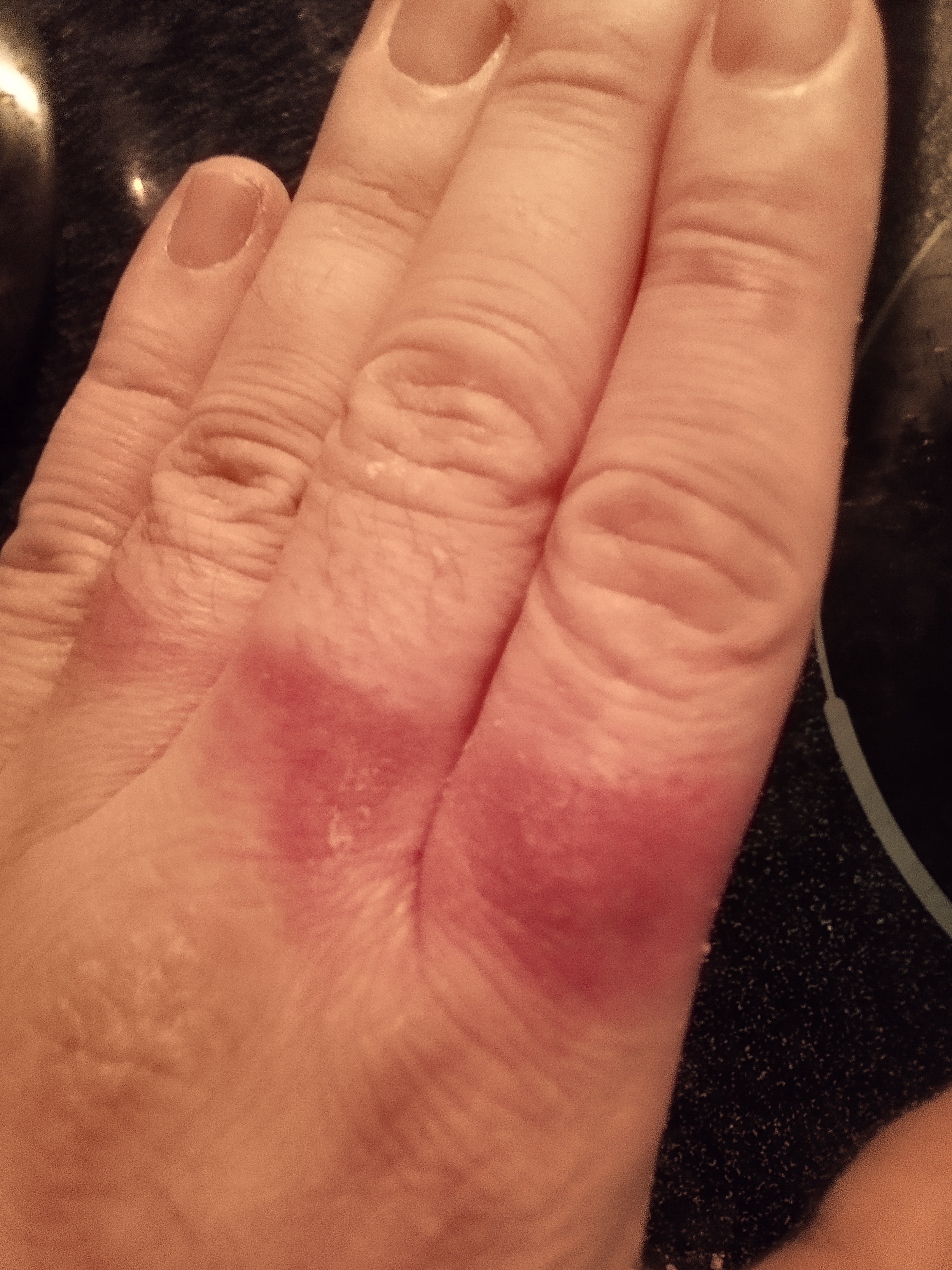 My burnt fingers healed up after a month, but that dark spot is a reminder of the second-degree burn.