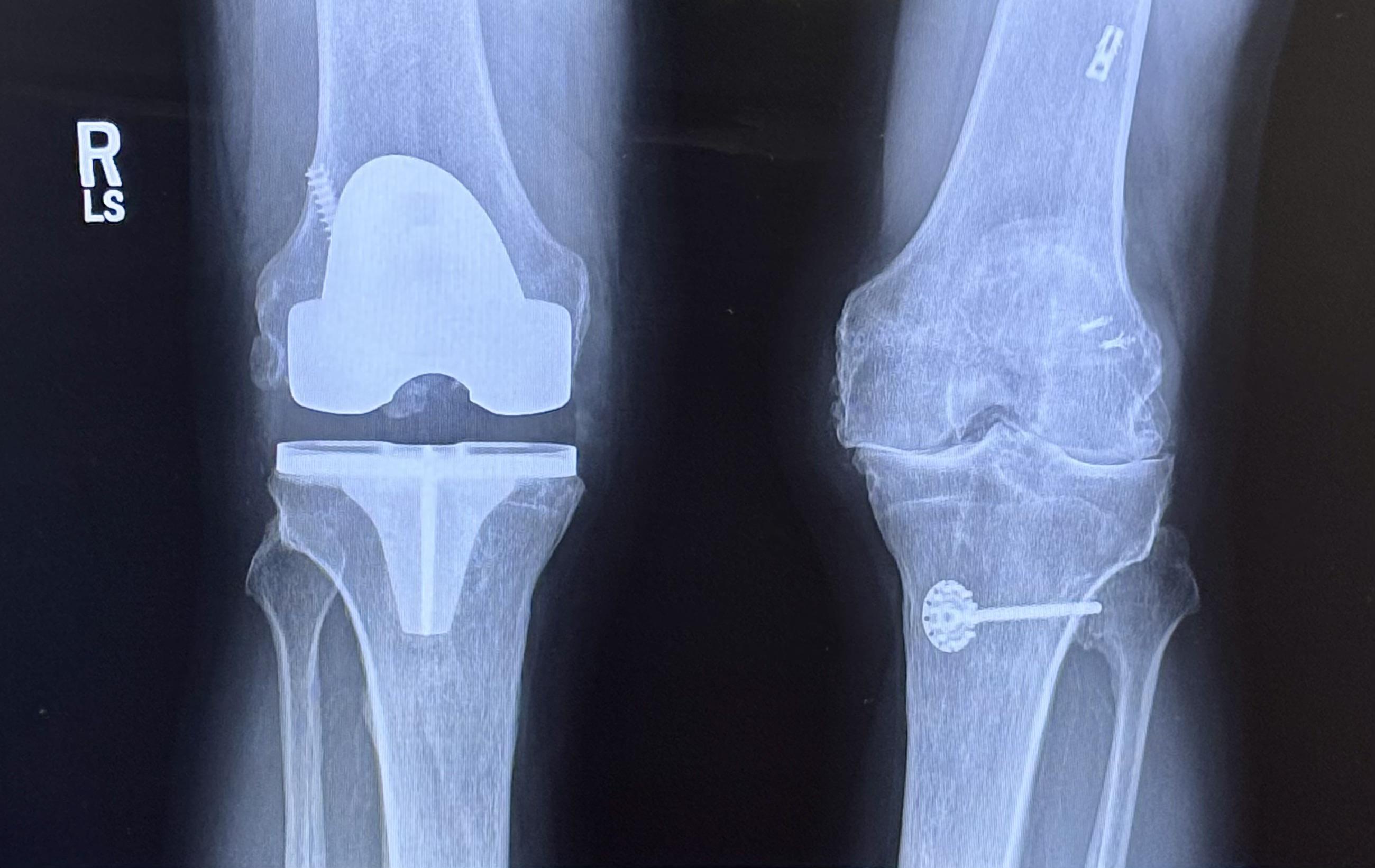 My Friend's New Right Knee Replacement: Next Up is the Left!