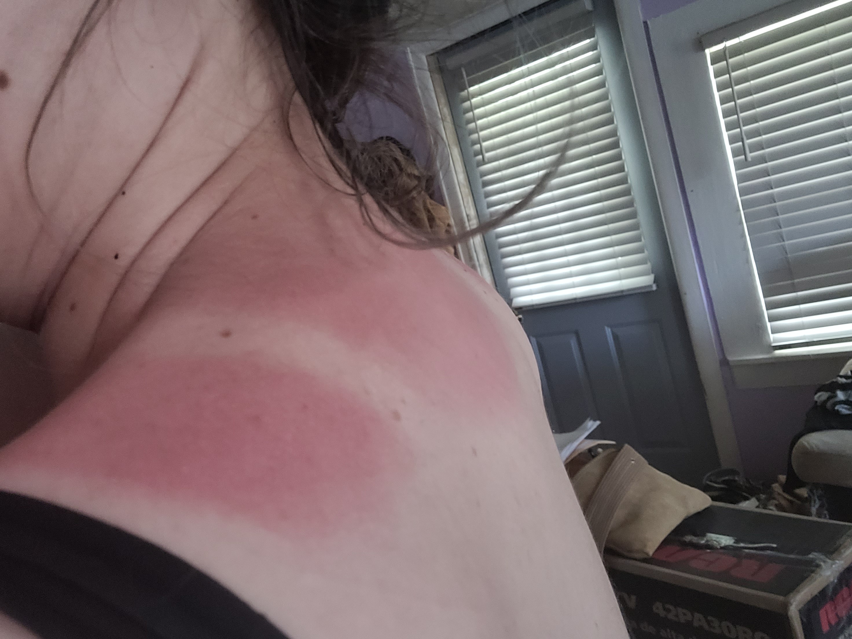 Once Upon a Time: Learning the Hard Way About Sunburn