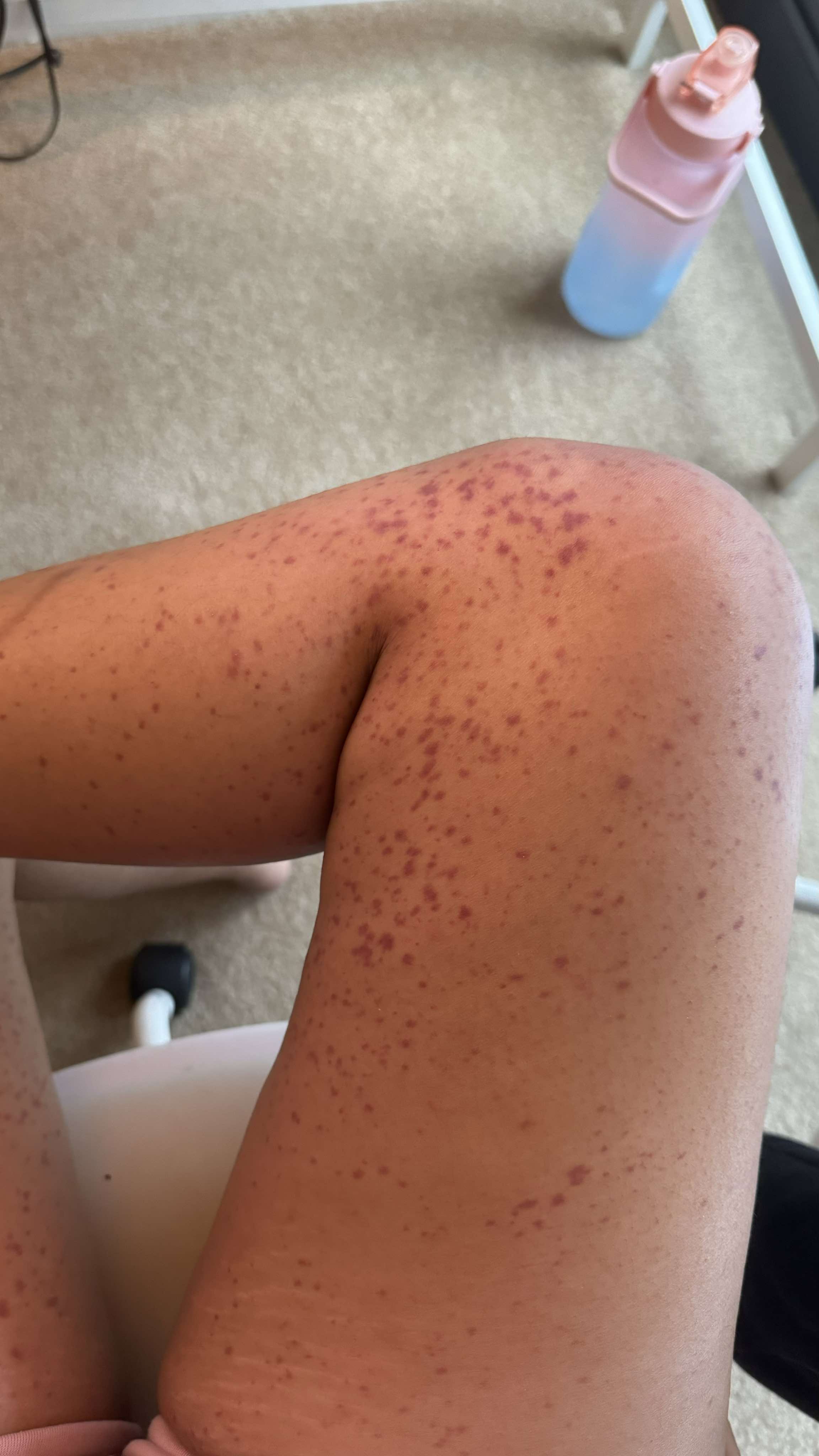 The Struggle of Petichae Rash