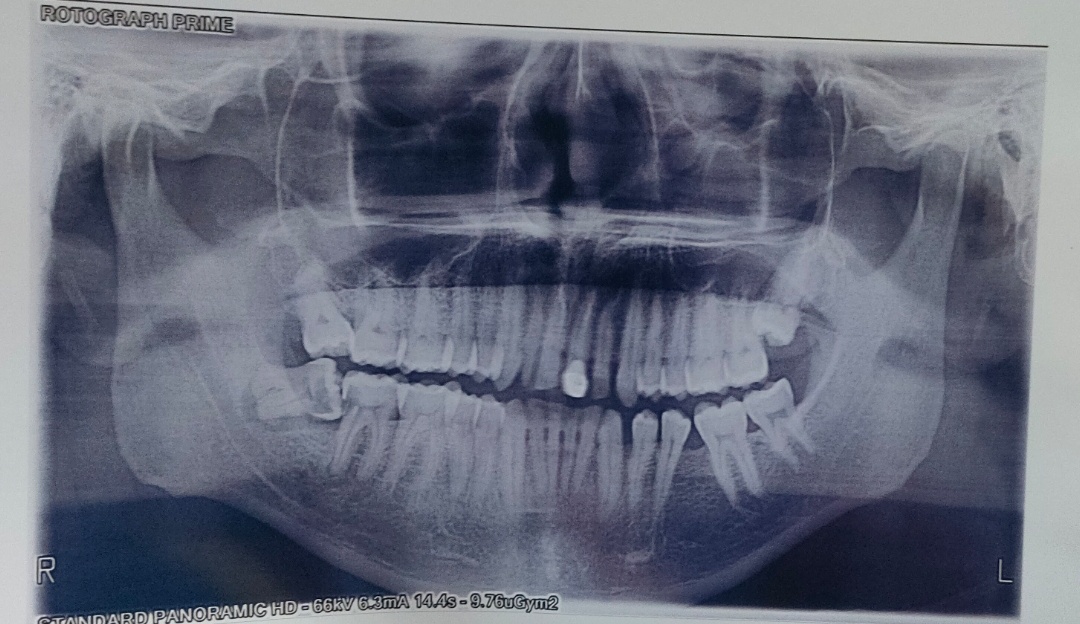 Insights from OPG Scans