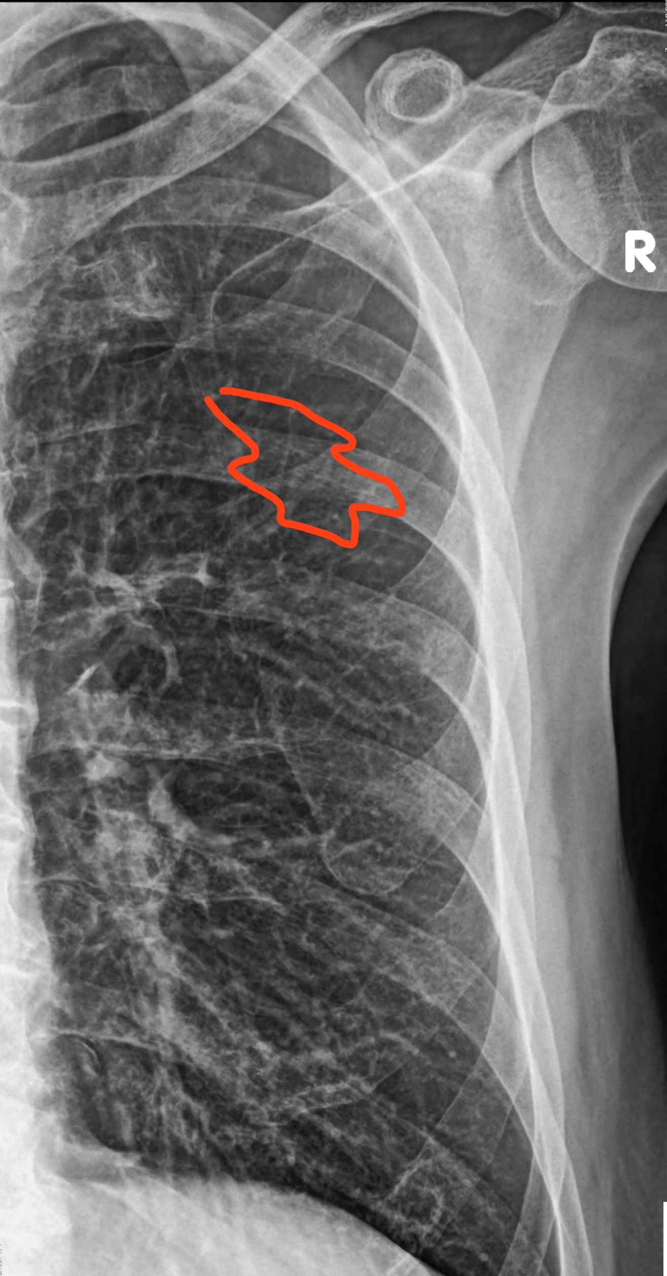 X-ray of the 5th rib: A glimpse inside