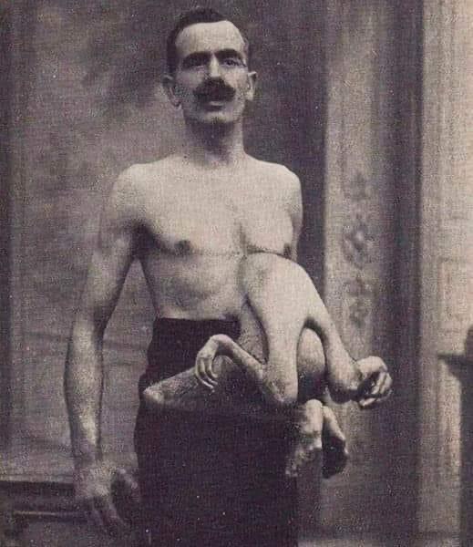 Meet Jean Libbera, the 'Double-Bodied Man,' who wowed audiences in the early 1900s alongside his parasitic twin brother Jacques.