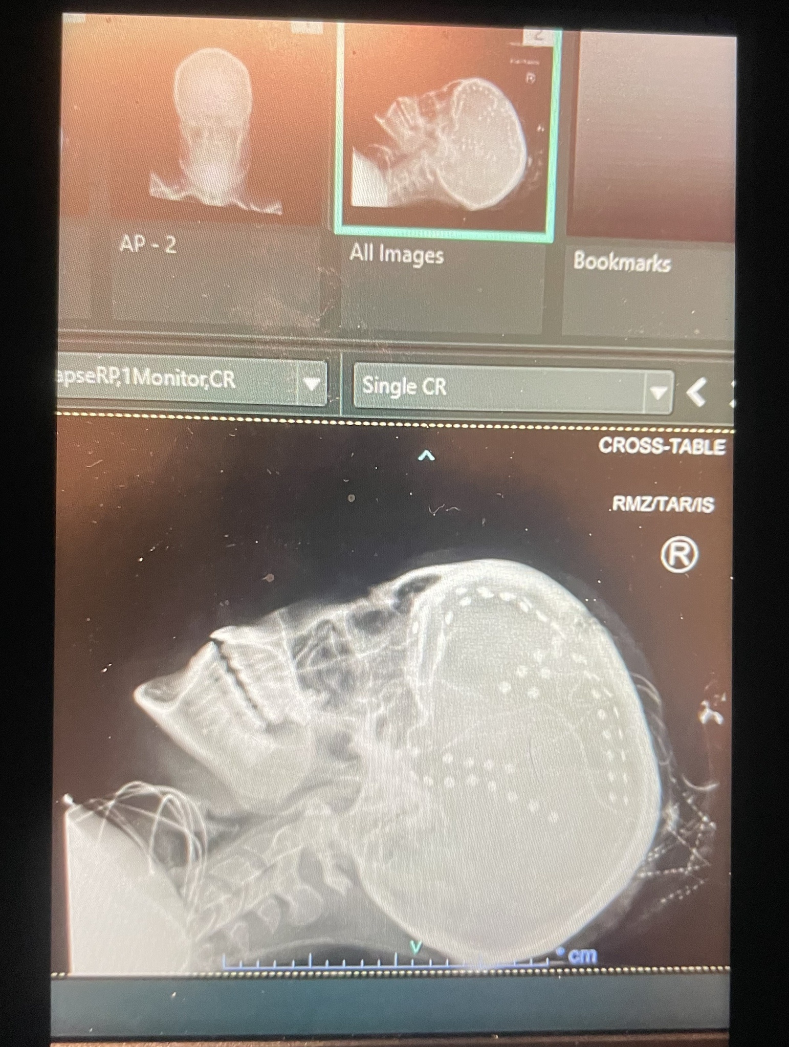 Updates on Subdural EEG and Temporal Lobectomy: Photos and Dates