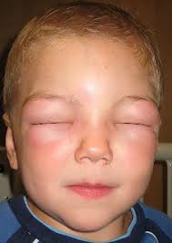 Forget the oaks and their annoying pollen!