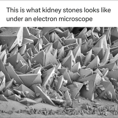 The Struggles of Kidney Stones...