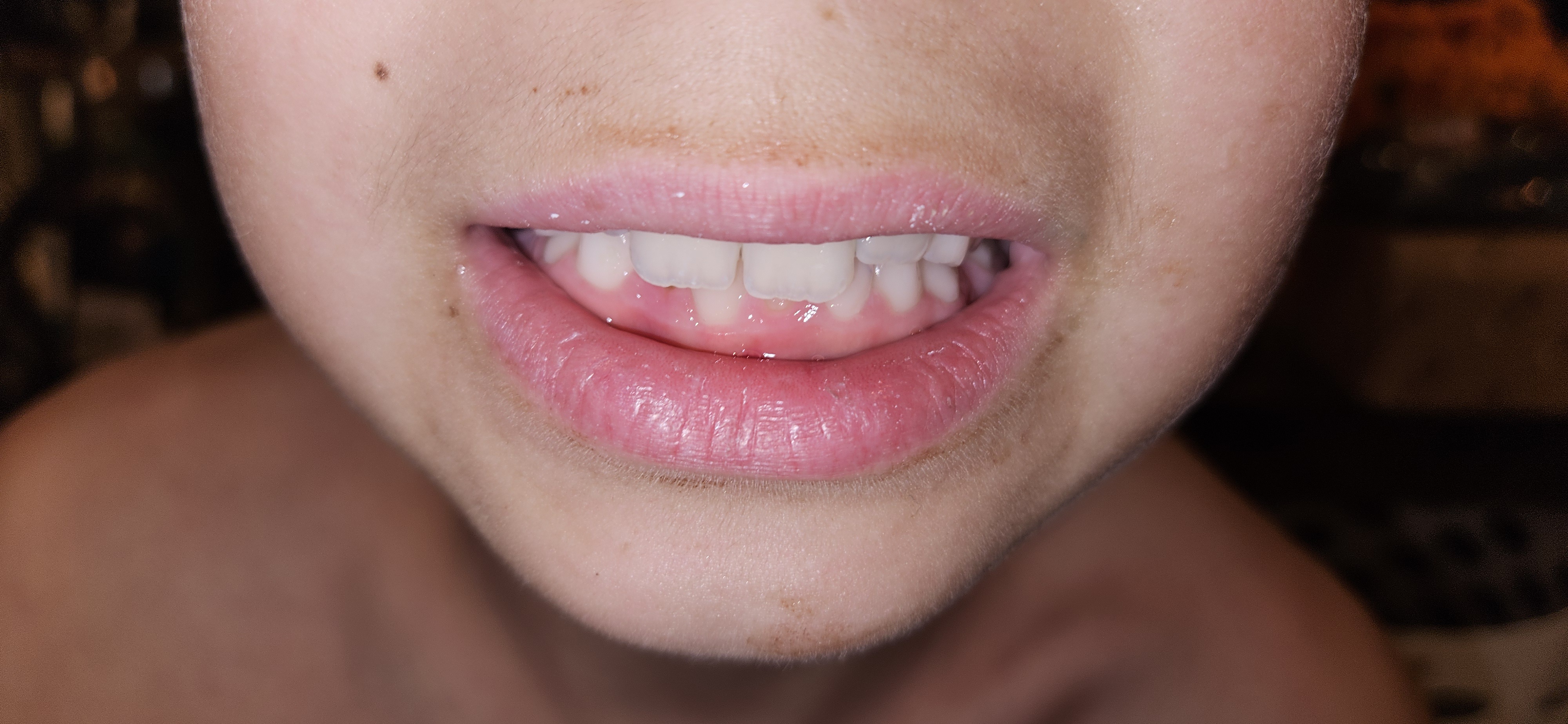 The Unique Features of an Acorn's Teeth