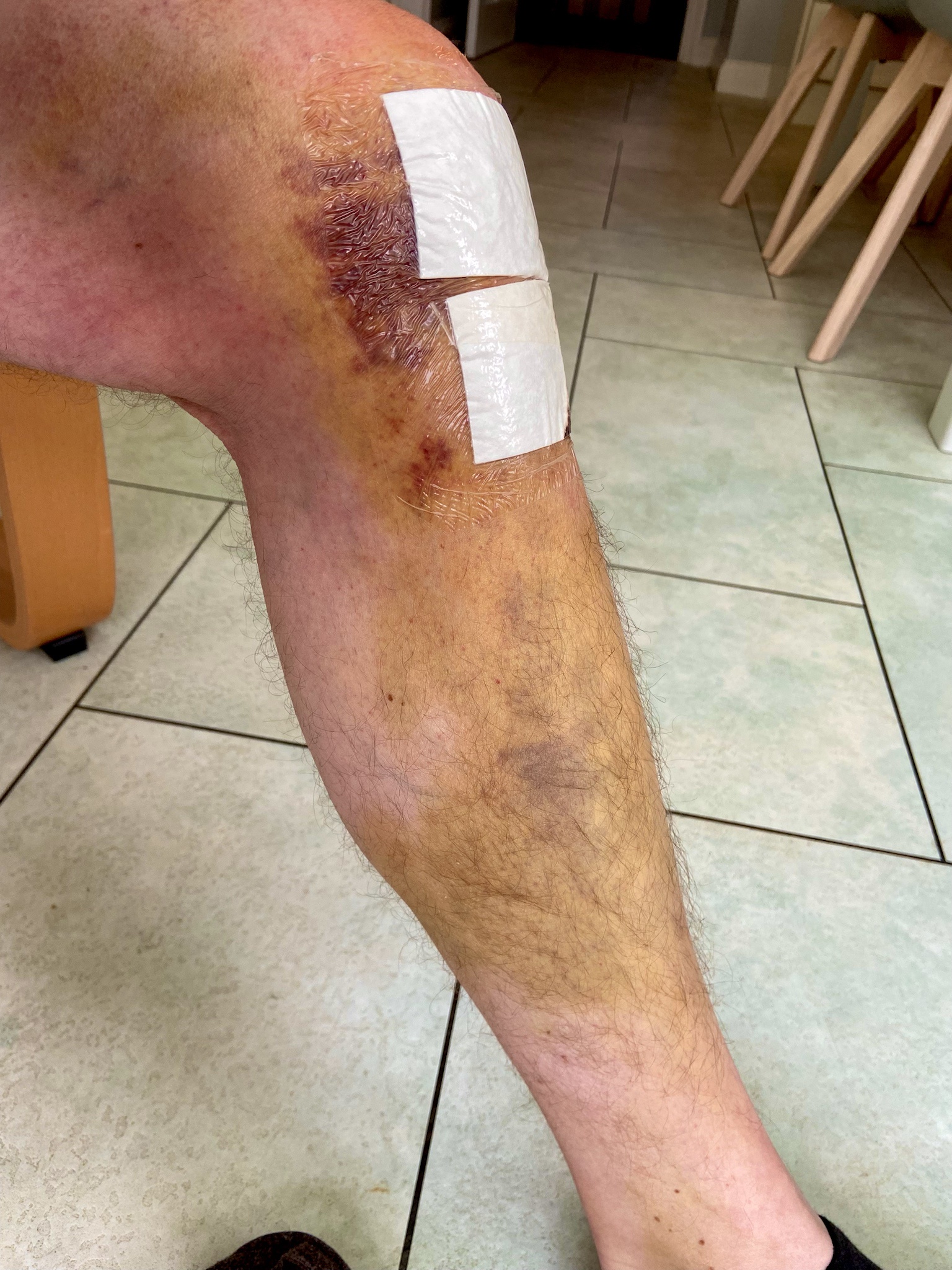 Surgery Update: Progress Report